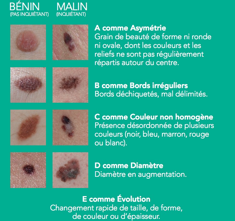 Cancers de la peau les signes qui doivent alerter